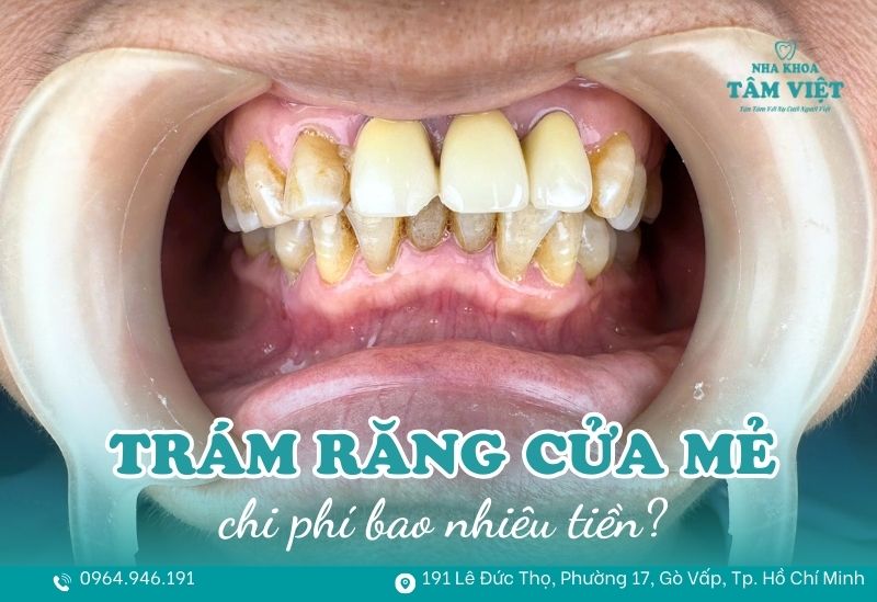 Trám răng cửa mẻ bao nhiêu tiền? Trám răng cửa có đau không? 1 trám răng cửa mẻ bao nhiêu tiền