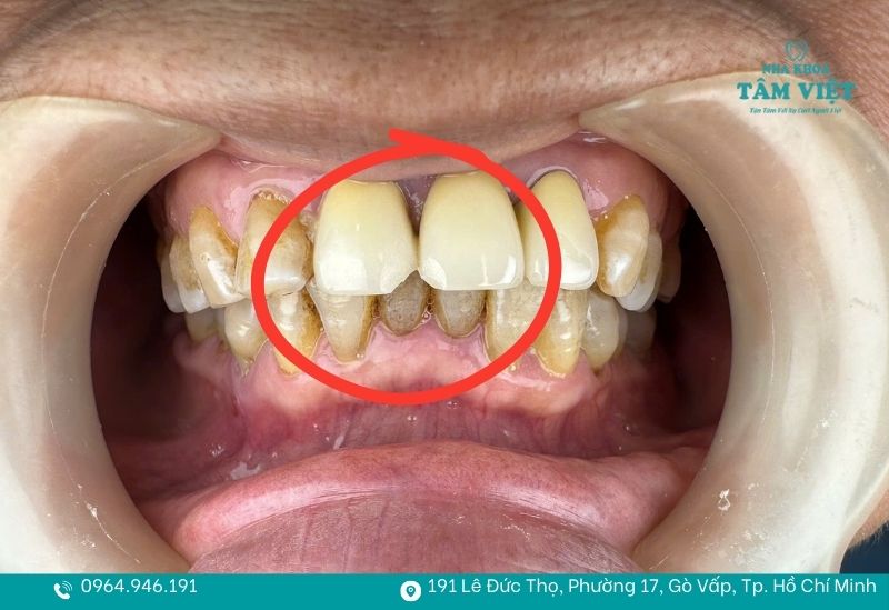 Trám răng cửa mẻ bao nhiêu tiền? Trám răng cửa có đau không? 4 Trám răng cửa là lựa chọn tối ưu cho các tổn thương nhỏ