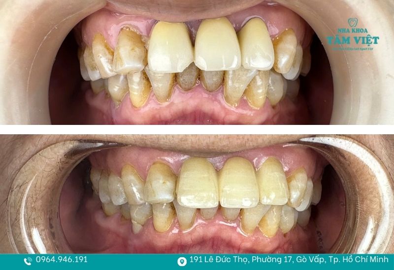 Trám răng cửa mẻ bao nhiêu tiền? Trám răng cửa có đau không? 6 Ưu đãi trám răng chỉ từ 49k