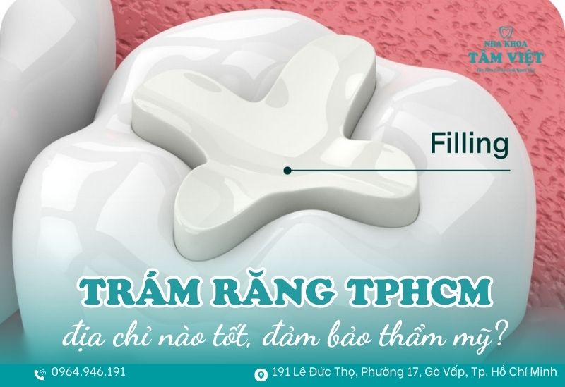 Gợi ý địa chỉ trám răng ở đâu tốt TPHCM đảm bảo thẩm mỹ 1 Trám răng ở đâu tốt TPHCM