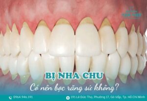 Bị nha chu có nên bọc răng sứ