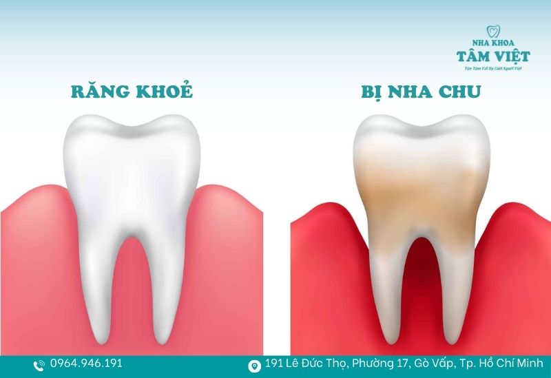 Bị nha chu có nên bọc răng sứ không hay chọn phương án khác? 2 Nha chu là tình trạng viêm nhiễm các tổ chức xung quanh răng