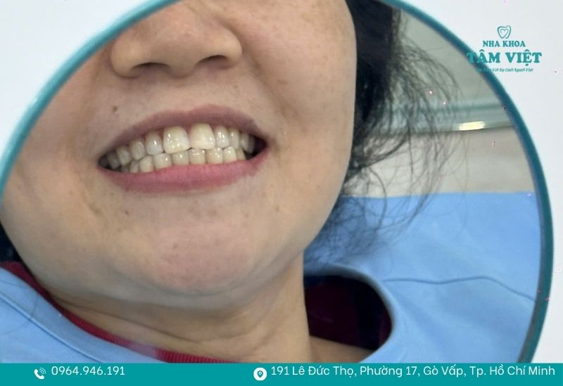 Bị nha chu có nên bọc răng sứ không hay chọn phương án khác? 4 Dán sứ Veneer