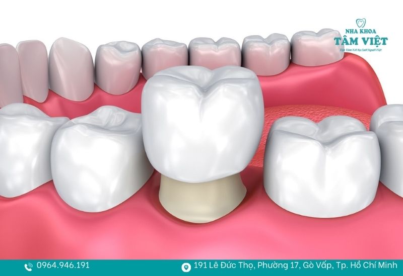 Bọc răng sứ 1 cái có được không? Chi phí và lưu ý cần biết 2 Bác sĩ có thể can thiệp một chiếc răng đơn lẻ