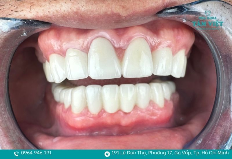 Bọc răng sứ có hết móm không? Hiểu đúng trước khi thực hiện 3 Bọc răng sứ có hết móm không?