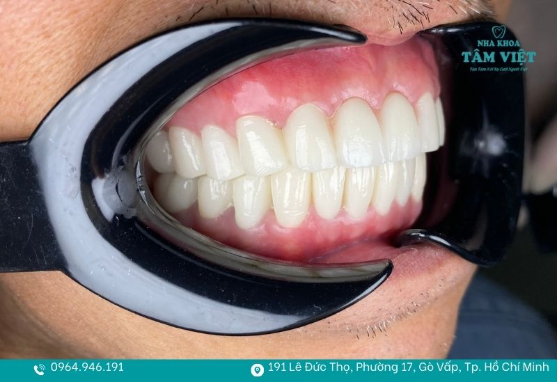 Trải nghiệm bọc răng sứ công nghệ mới TPHCM an toàn, thẩm mỹ 2 Chuẩn xác đến từng micrometer
