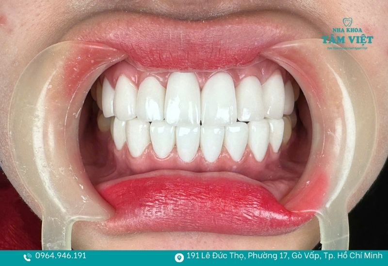 Nên bọc răng sứ loại nào tốt, bền đẹp và giá hợp lý nhất? 3 Răng toàn sứ Zirconia