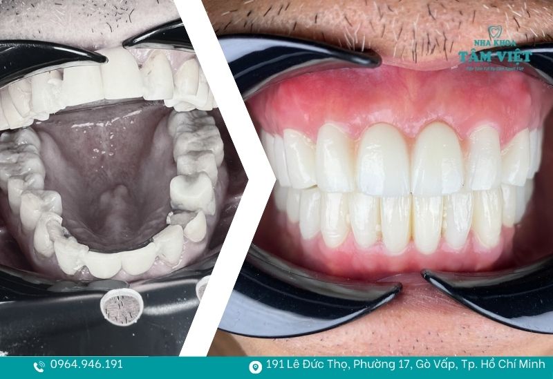 Bọc răng sứ ở đâu uy tín TPHCM? Review thực tế từ khách hàng 4 Đầy đủ các dòng răng sứ chính hãng