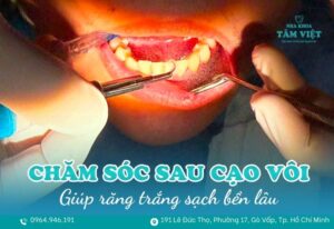 chăm sóc răng sau khi cạo vôi