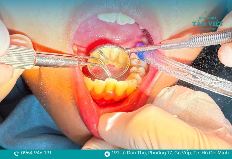 Cạo vôi răng sóng siêu âm