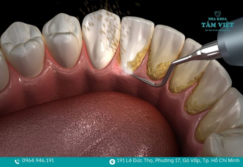 Địa chỉ cạo vôi răng gần đây làm nhanh, sạch, không đau 4 Cạo vôi răng bằng sóng siêu âm hiện đại