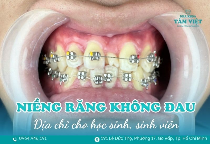 Địa chỉ niềng răng không đau TPHCM cho học sinh, sinh viên 1 Địa chỉ niềng răng không đau TPHCM