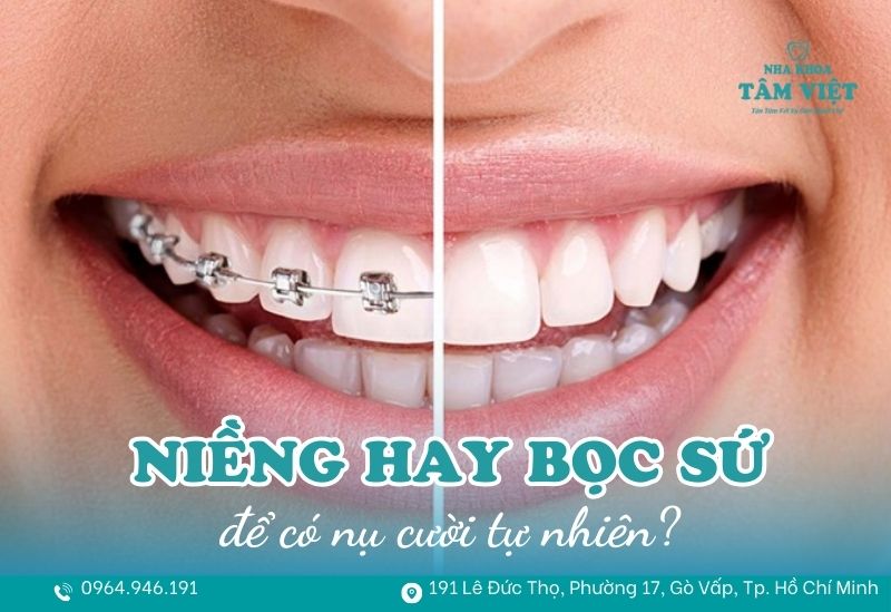 Nên niềng răng hay bọc sứ để có nụ cười đẹp tự nhiên? 1 nên niềng răng hay bọc sứ