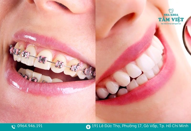 Nên niềng răng hay bọc sứ để có nụ cười đẹp tự nhiên? 2 Nên niềng răng hay bọc sứ?