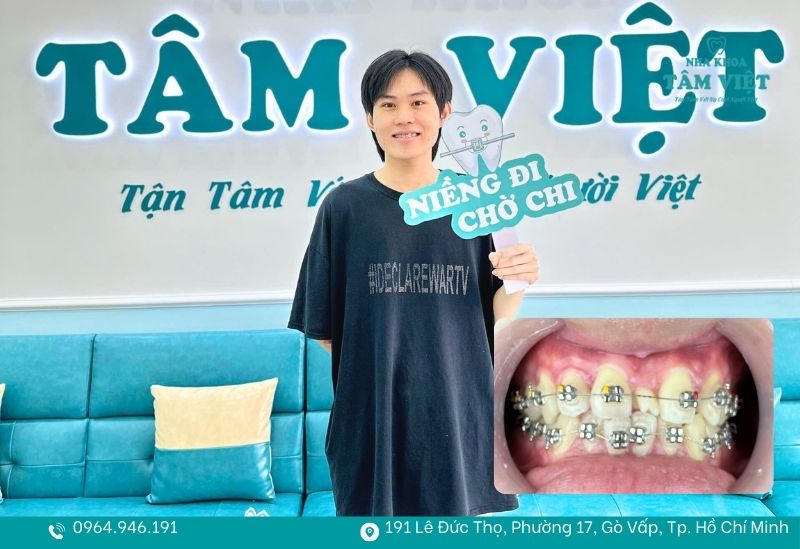 Nên niềng răng hay bọc sứ để có nụ cười đẹp tự nhiên? 4 Niềng răng khấp khểnh