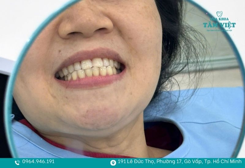 Dán sứ Veneer bảo tồn răng thật đến 99%