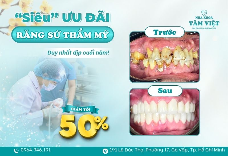 Bọc răng sứ thẩm mỹ được ưu đãi giảm đến 50%