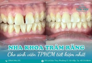 nha khoa trám răng giá rẻ cho sinh viên