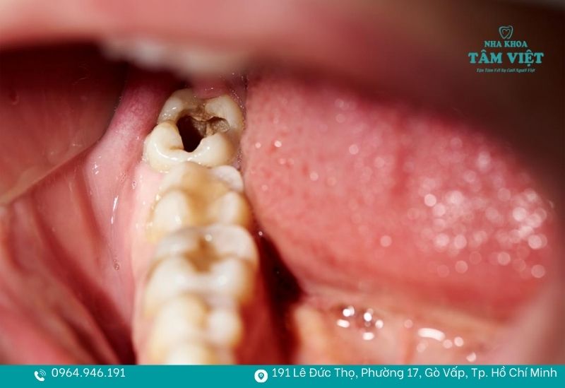 Bạn nên trám răng ngay khi có dấu hiệu sâu