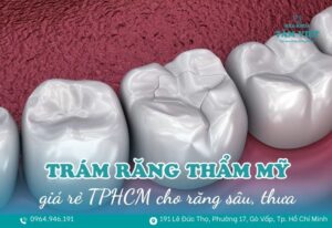 nha khoa trám răng thẩm mỹ giá rẻ