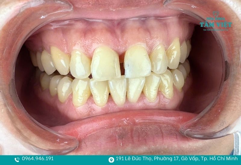 Nha khoa trám răng thẩm mỹ giá rẻ TPHCM cho răng sâu, thưa 2 Răng thưa kẽ khiến nụ cười "kém duyên"