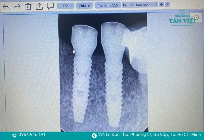 Nha khoa trồng implant an toàn tại TPHCM trả góp lãi suất 0% 4 Ứng dụng công nghệ hiện đại trong cấy ghép implant