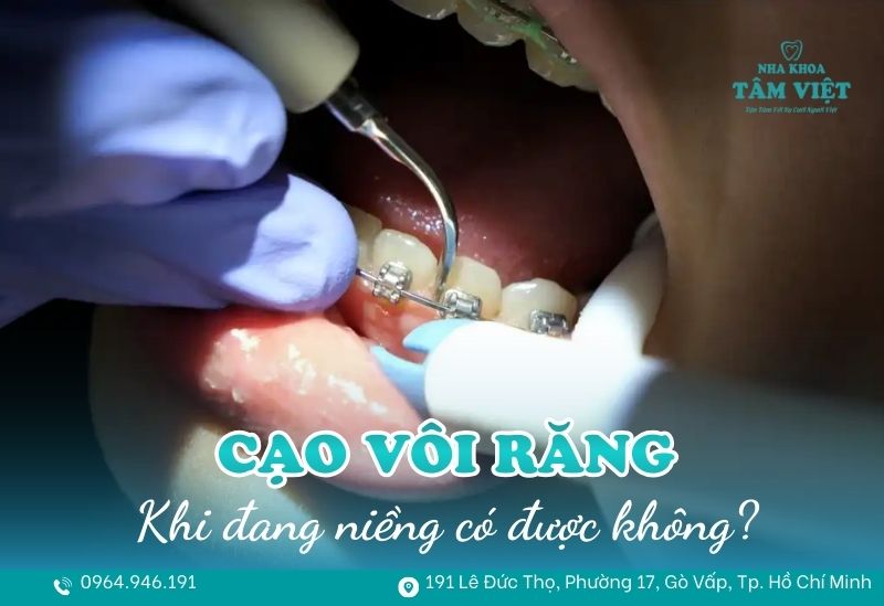 Đang niềng răng có cạo vôi răng được không, có đau không? 1 niềng răng có cạo vôi răng được không