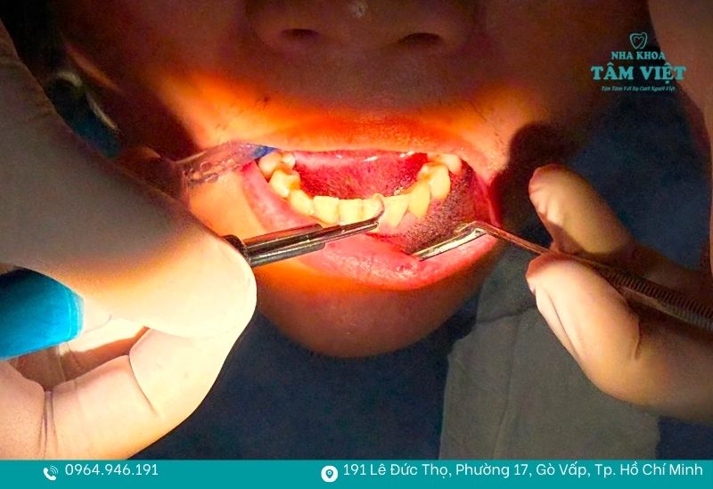 Đang niềng răng có cạo vôi răng được không, có đau không? 3 Cạo vôi răng giúp răng sạch sẽ hơn