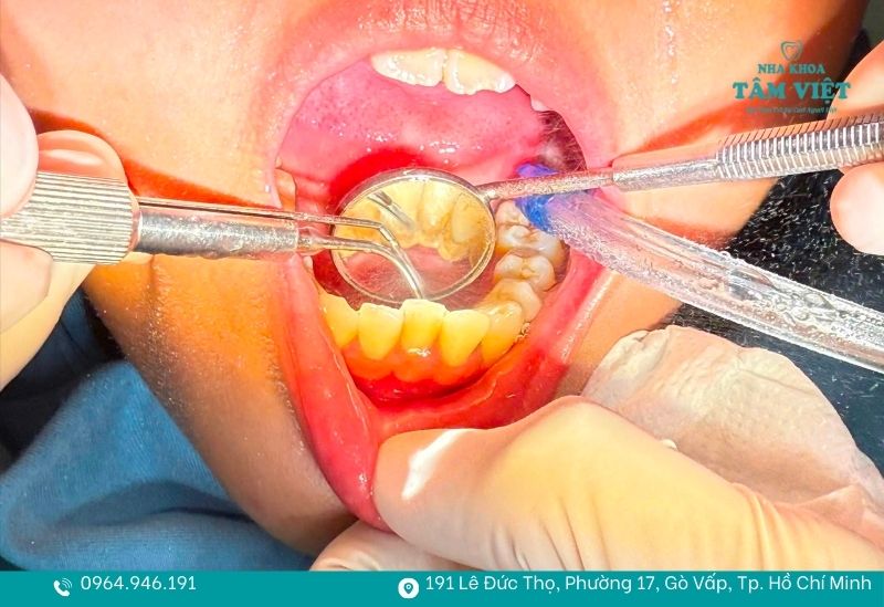 Đang niềng răng có cạo vôi răng được không, có đau không? 4 Quy trình cạo vôi răng an toàn