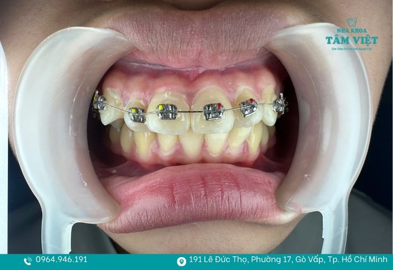 Đang niềng răng có cạo vôi răng được không, có đau không? 5 Chăm sóc để răng niềng luôn khoẻ mạnh