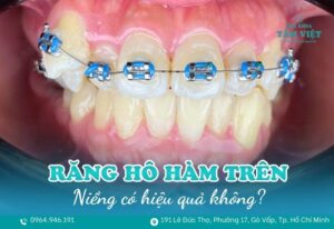 niềng răng hô hàm trên