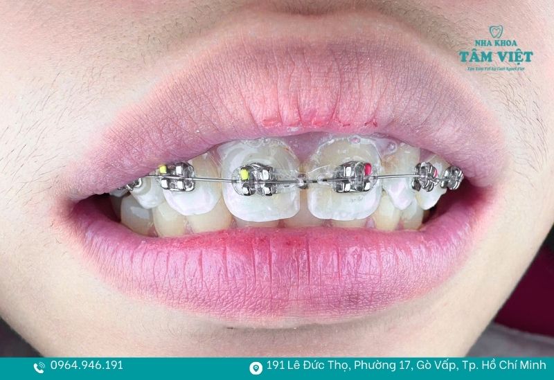 Niềng răng hô hàm trên 