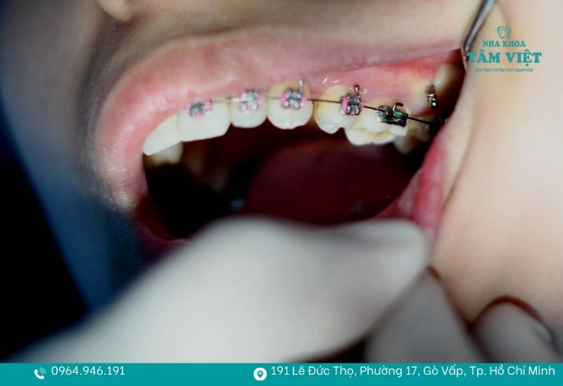 Niềng răng phù hợp với trường hợp hô do răng