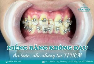 Niềng răng thẩm mỹ không đau TPHCM