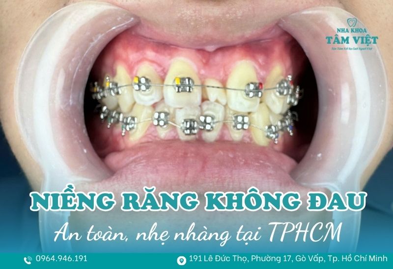 Niềng răng thẩm mỹ không đau TPHCM an toàn, nhẹ nhàng 1 Niềng răng thẩm mỹ không đau TPHCM