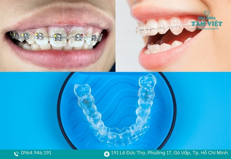 Niềng răng thẩm mỹ không đau TPHCM an toàn, nhẹ nhàng 4 Các phương pháp niềng răng êm ái