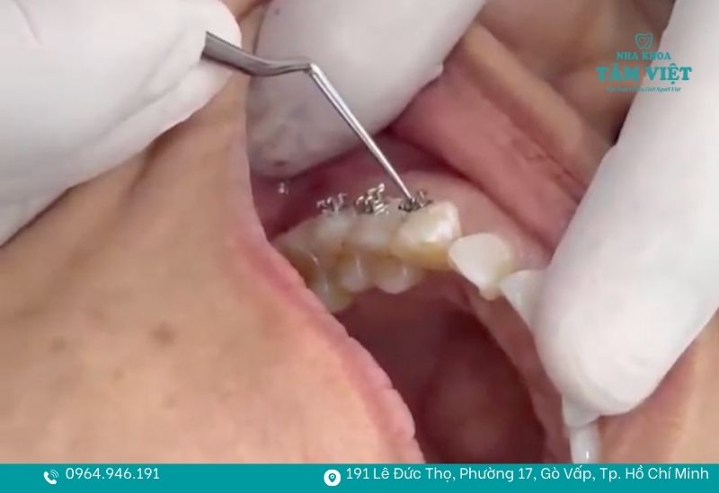 Niềng răng thẩm mỹ không đau TPHCM an toàn, nhẹ nhàng 5 Niềng răng không đau tại Nha khoa Tâm Việt