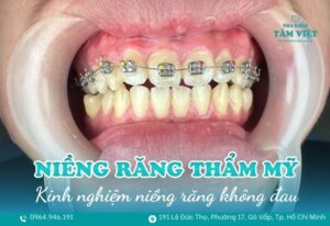 Niềng răng thẩm mỹ TPHCM