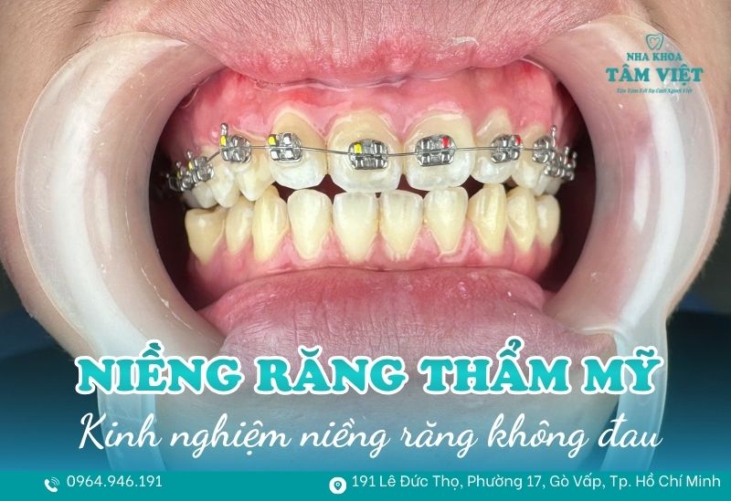 Kinh nghiệm niềng răng thẩm mỹ TPHCM không đau bạn cần biết 1 Niềng răng thẩm mỹ TPHCM