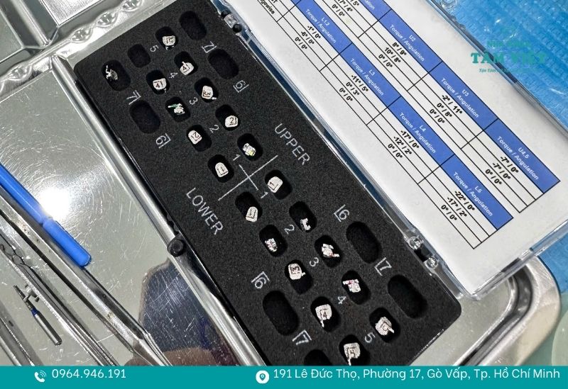 Kinh nghiệm niềng răng thẩm mỹ TPHCM không đau bạn cần biết 4 Lựa chọn khí cụ niềng răng phù hợp