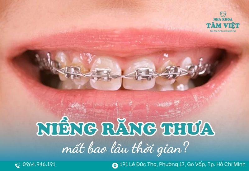 Niềng răng thưa mất bao lâu và làm sao để rút ngắn thời gian? 1 Niềng răng thưa mất bao lâu