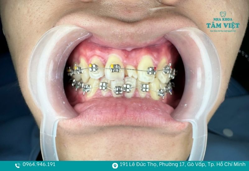 Niềng răng thưa mất bao lâu và làm sao để rút ngắn thời gian? 3 Niềng răng thưa phức tạp