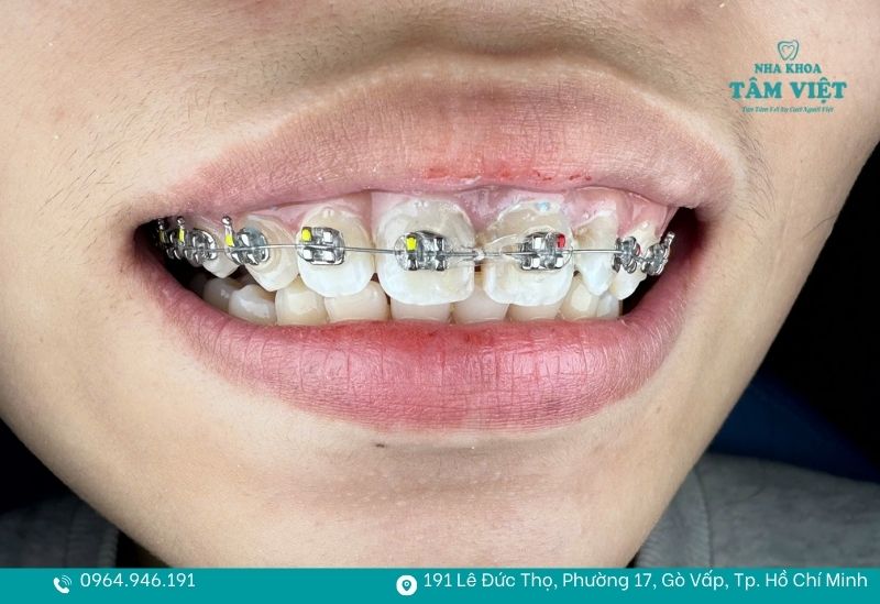 Niềng răng thưa mất bao lâu và làm sao để rút ngắn thời gian? 6 Khách hàng niềng răng tại Nha khoa Tâm Việt