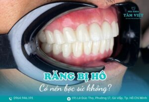 răng hô có nên bọc sứ không