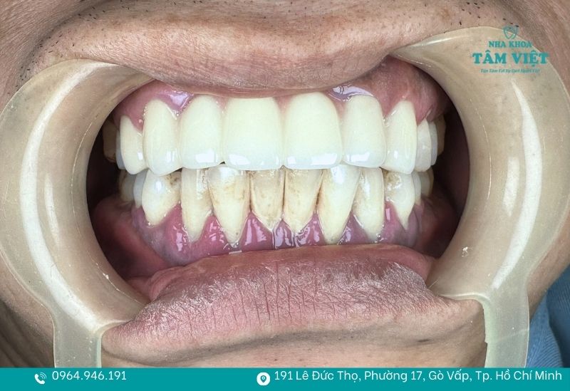 Sự thật răng hô có nên bọc sứ không? Ưu và nhược điểm cần biết 2 Răng cửa hàm trên chìa ra trước