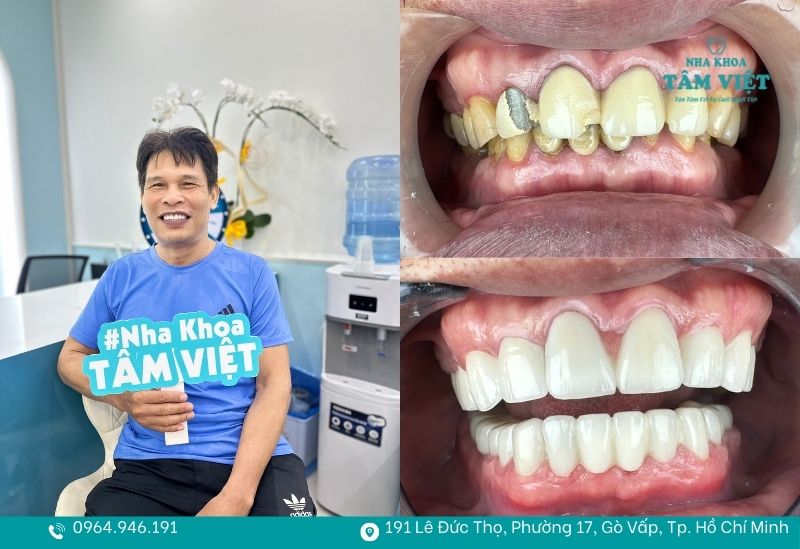 Sự thật răng hô có nên bọc sứ không? Ưu và nhược điểm cần biết 5 Răng sứ chỉ có tác dụng thay đổi hình dáng