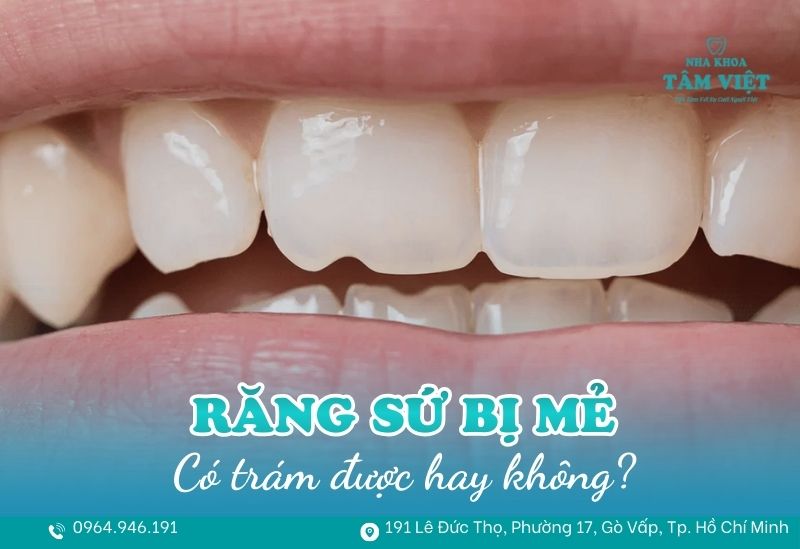 răng sứ bị mẻ có trám được không