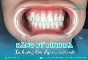răng sứ đính đá được không