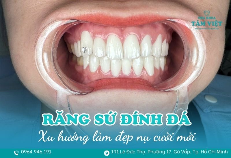 răng sứ đính đá được không