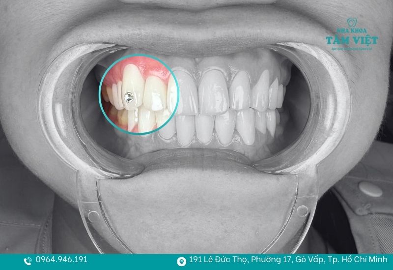 Răng sứ vẫn có thể đính đá